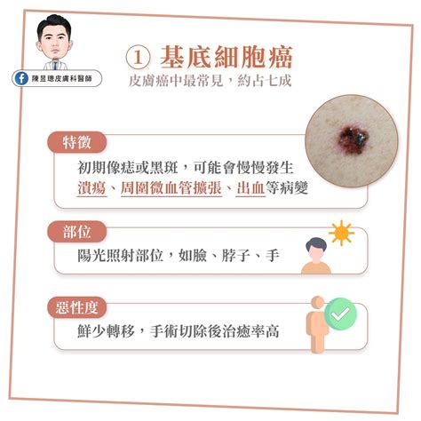 多痣體質|皮膚長痣、長斑是皮膚癌前兆？皮膚癌初期4大症狀快。